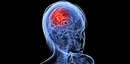 Beyin Metastazı Belirtileri ve Tedavisi