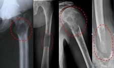Kemik Metastaz Belirtileri Nelerdir?