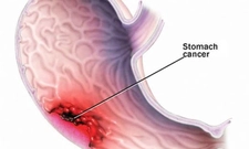 Mide Kanseri Beyin Metastazı