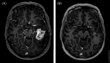 İyi Huylu Tümör Metastaz Yapar mı?