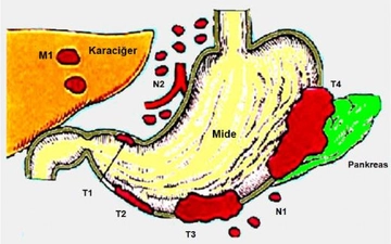 Mide Kanseri Karaciğer Metastazı