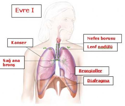 Akciğer Kanseri Metastaz Belirtileri ve Tedavisi