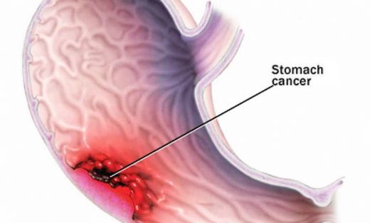 Mide Kanseri Metastaz Belirtileri ve Tedavisi